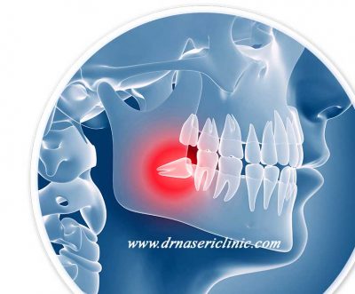 Wisdom teeth