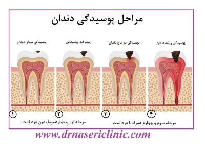 عوارض پوسیدگی دندان,ترمیم دندان,