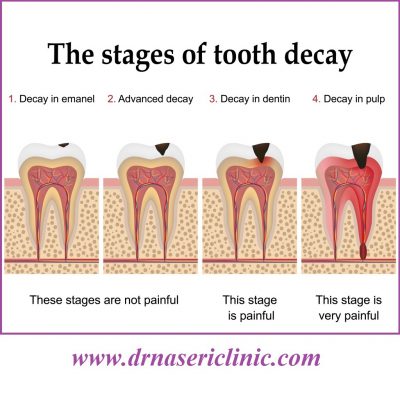 health risks of tooth decay