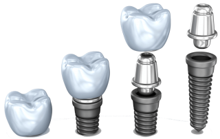 کلینیک دندانپزشکی دکتر سید رضا ناصری,لیرینگ دندان,ایمپلنت دندان مرکز ایمپلنت دندان