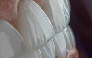 کلینیک دندانپزشکی دکتر سید رضا ناصری,لیرینگ دندان,ایمپلنت دندان,کامپوزیت ونیر دندان,لمینت دندان