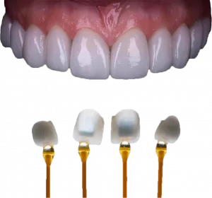 کلینیک دندانپزشکی دکتر سید رضا ناصری,لیرینگ دندان,ایمپلنت دندان,کامپوزیت ونیر دندا,لمینت دندانن