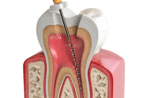 کلینیک دندانپزشکی دکتر سید رضا ناصری,لیرینگ دندان,ایمپلنت دندان,کامپوزیت ونیر دندان,لمینت دندان,جرمگیری دندان,جراحی لثه,درمان ریشه,مرکز عصب کشی دندان