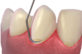 کلینیک دندانپزشکی دکتر سید رضا ناصری,لیرینگ دندان,ایمپلنت دندان,کامپوزیت ونیر دندان,لمینت دندان,جرمگیری دندان,