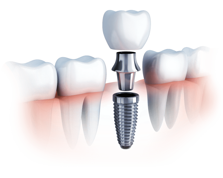 کلینیک دندانپزشکی دکتر سید رضا ناصری,لیرینگ دندان,ایمپلنت دندان