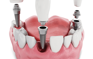 کلینیک دندانپزشکی دکتر سید رضا ناصری,لیرینگ دندان,ایمپلنت دندان,کامپوزیت ونیر دندان